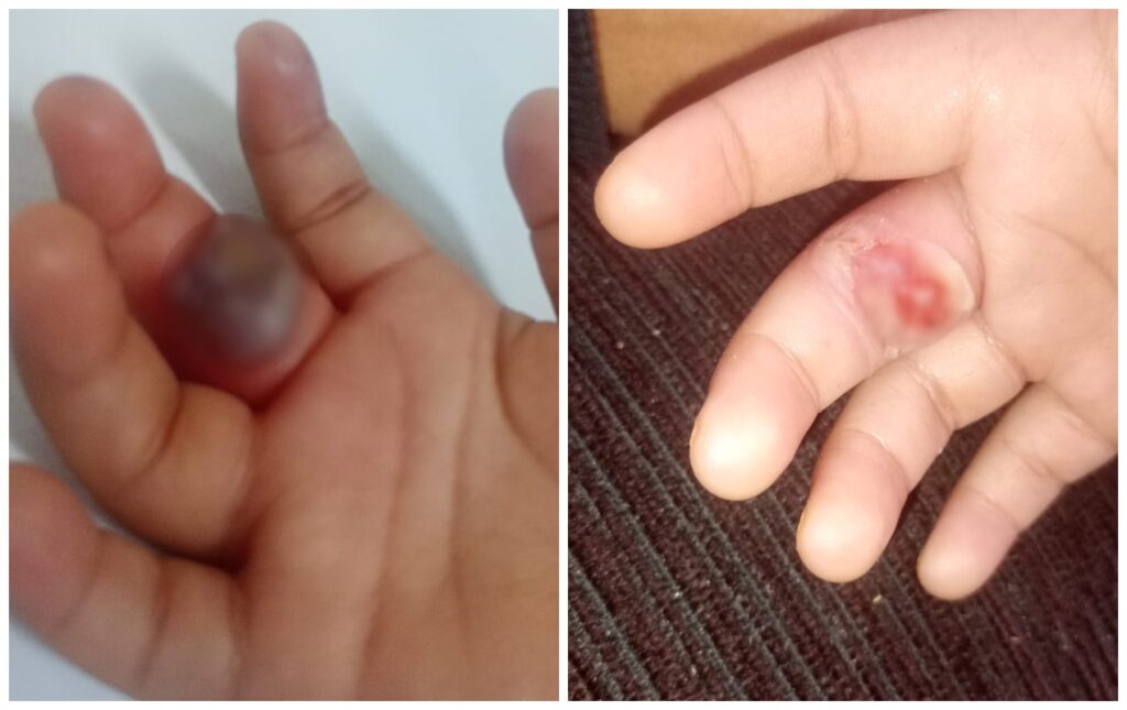 Criança Sofre Lesão em Dedo Após Picada de Aranha; Mãe Relata Suspeitas Sobre Creche