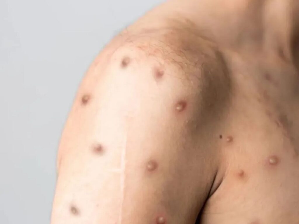Jundiaí Registra Primeiro Caso de Mpox em 2026: Entenda os Riscos e Sintomas